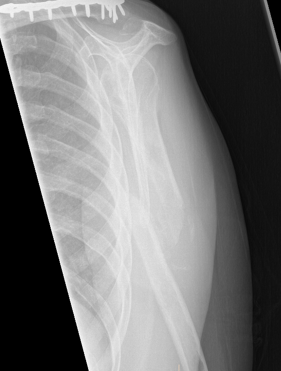 Humerus nonunion